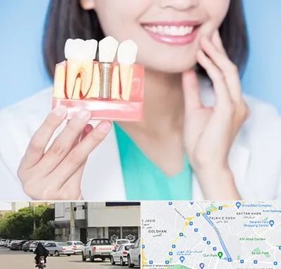 متخصص ایمپلنت در قدوسی شرقی شیراز