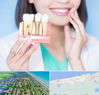 متخصص ایمپلنت در فریدونکنار