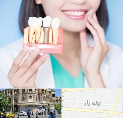 متخصص ایمپلنت در لاله زار