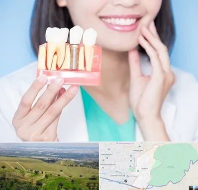 متخصص ایمپلنت در سوهانک