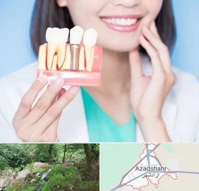 متخصص ایمپلنت در آزادشهر