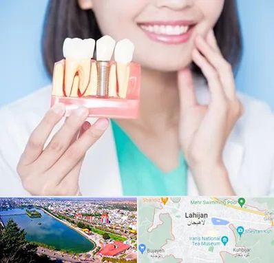 متخصص ایمپلنت در لاهیجان
