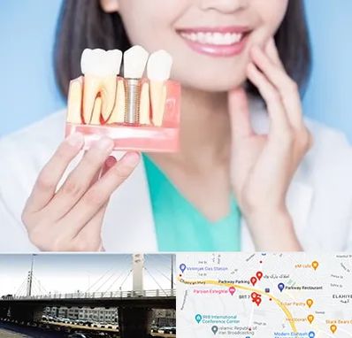 متخصص ایمپلنت در پارک وی