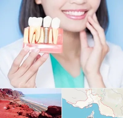 متخصص ایمپلنت در هرمزگان