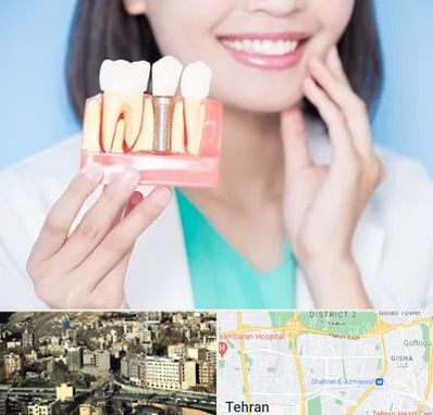 متخصص ایمپلنت در مرزداران