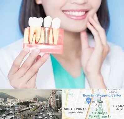 متخصص ایمپلنت در پونک