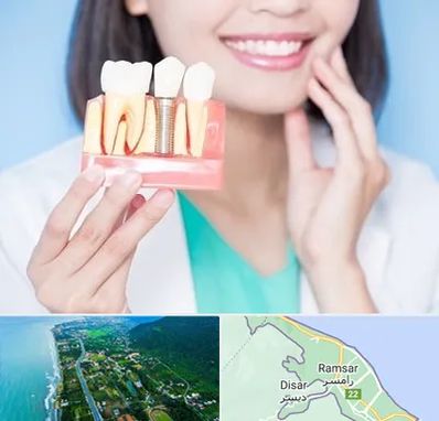 متخصص ایمپلنت در رامسر