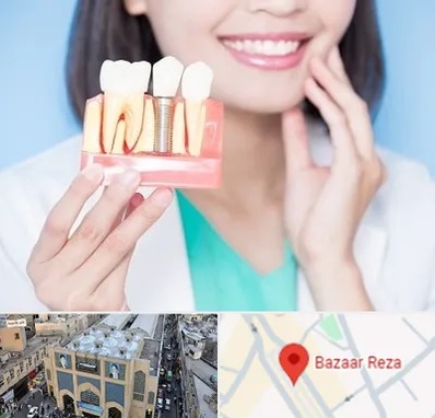 متخصص ایمپلنت در بازار رضا مشهد