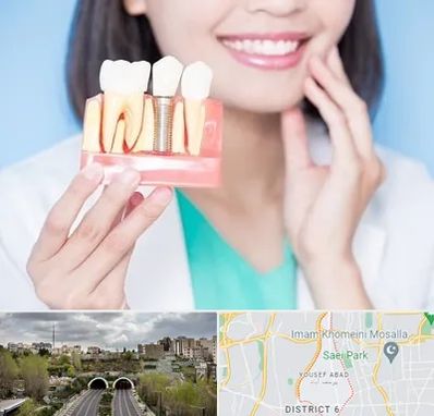 متخصص ایمپلنت در یوسف آباد