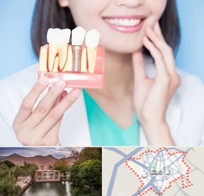 متخصص ایمپلنت در دامغان