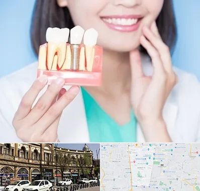 متخصص ایمپلنت در منطقه 11 تهران