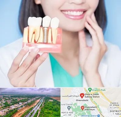 متخصص ایمپلنت در قصرالدشت شیراز