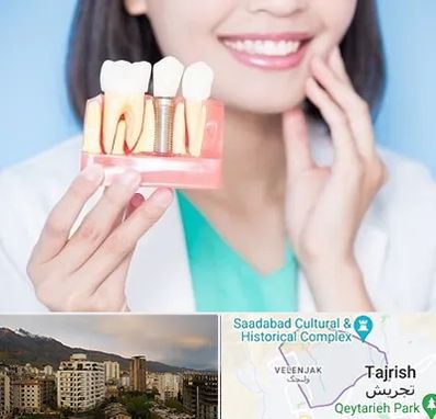 متخصص ایمپلنت در زعفرانیه