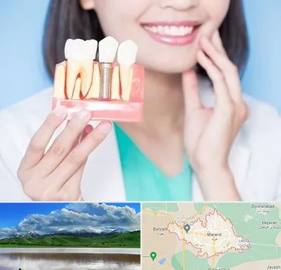 متخصص ایمپلنت در مرند