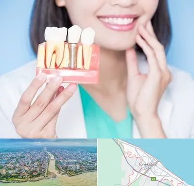 متخصص ایمپلنت در تنکابن