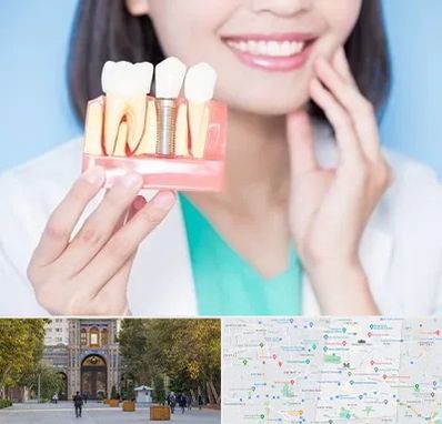 متخصص ایمپلنت در منطقه 12 تهران