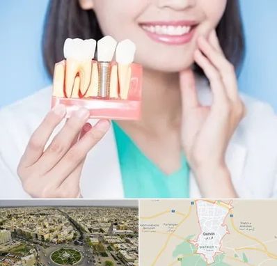 متخصص ایمپلنت در قزوین