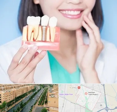 متخصص ایمپلنت در فاز سه اندیشه