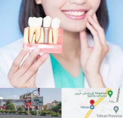 متخصص ایمپلنت در هروی