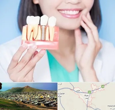 متخصص ایمپلنت در بیجار