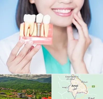 متخصص ایمپلنت در آمل