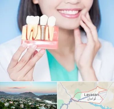 متخصص ایمپلنت در لواسان