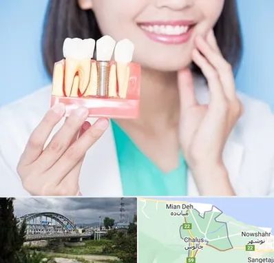 متخصص ایمپلنت در چالوس