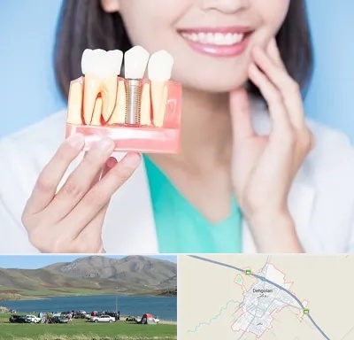 متخصص ایمپلنت در دهگلان