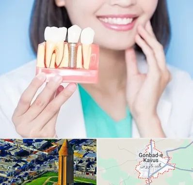 متخصص ایمپلنت در گنبد کاووس