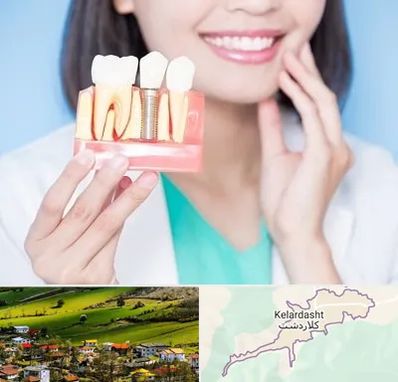 متخصص ایمپلنت در کلاردشت