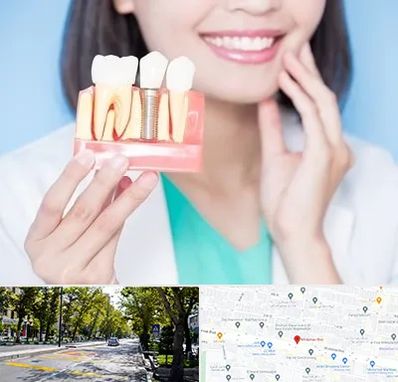 متخصص ایمپلنت در میرداماد