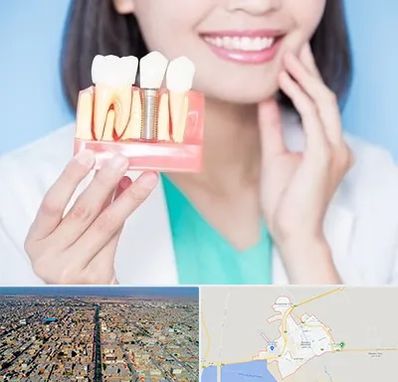 متخصص ایمپلنت در بندر ماهشهر