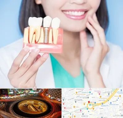 متخصص ایمپلنت در میدان ولیعصر