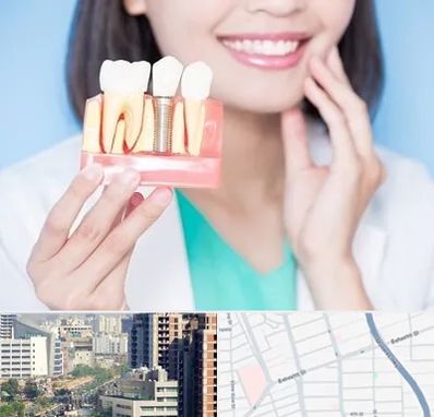 متخصص ایمپلنت در خیابان بهشتی