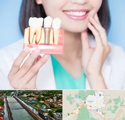 متخصص ایمپلنت در مراغه