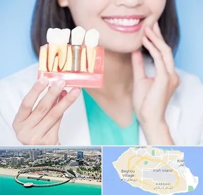 متخصص ایمپلنت در کیش