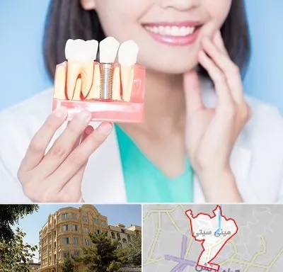 متخصص ایمپلنت در مینی سیتی
