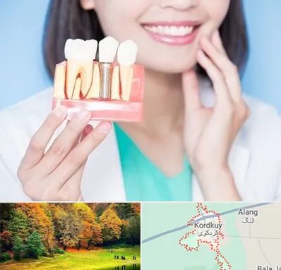 متخصص ایمپلنت در کردکوی