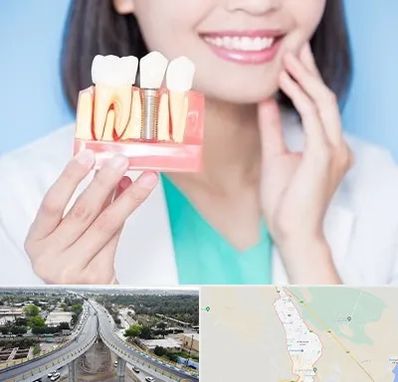 متخصص ایمپلنت در اندیمشک