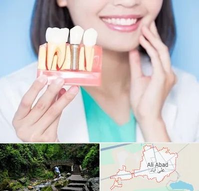 متخصص ایمپلنت در علی آباد کتول