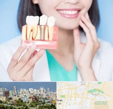 متخصص ایمپلنت در شرق تهران