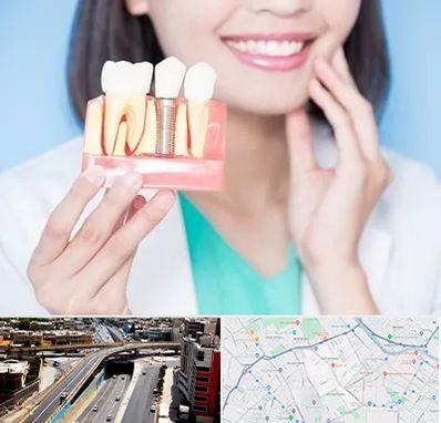 متخصص ایمپلنت در ستارخان شیراز