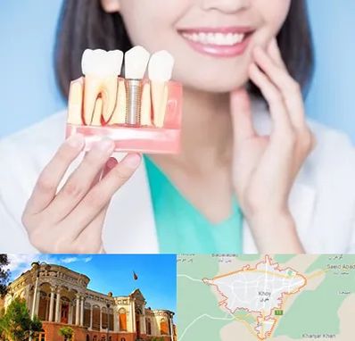 متخصص ایمپلنت در خوی