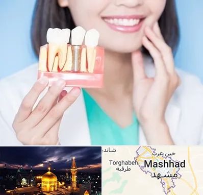 متخصص ایمپلنت در مشهد