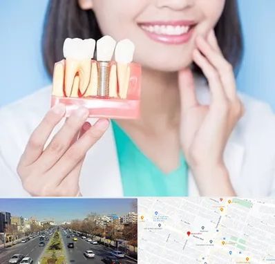 متخصص ایمپلنت در بلوار معلم مشهد