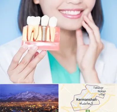 متخصص ایمپلنت در کرمانشاه