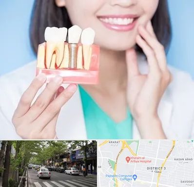 متخصص ایمپلنت در ظفر