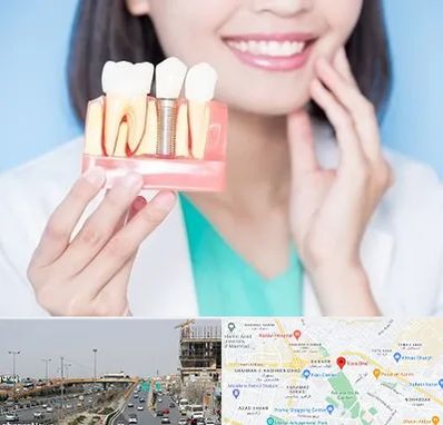 متخصص ایمپلنت در بلوار توس مشهد