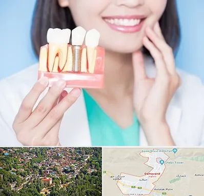 متخصص ایمپلنت در دماوند