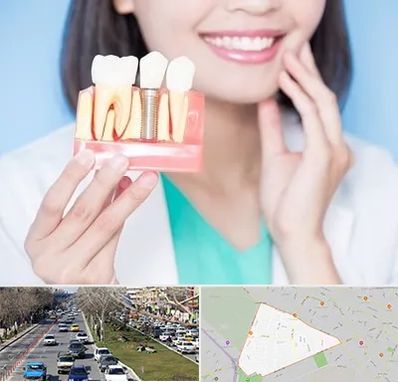 متخصص ایمپلنت در احمدآباد مشهد